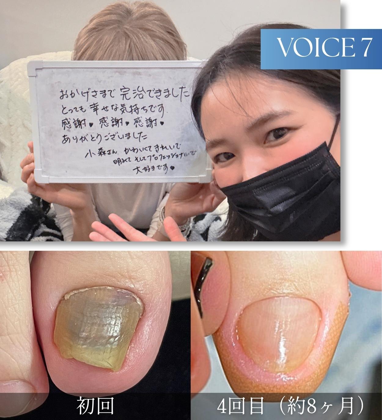 変形爪・肥厚爪・変色で悩んでいたお客様の声7